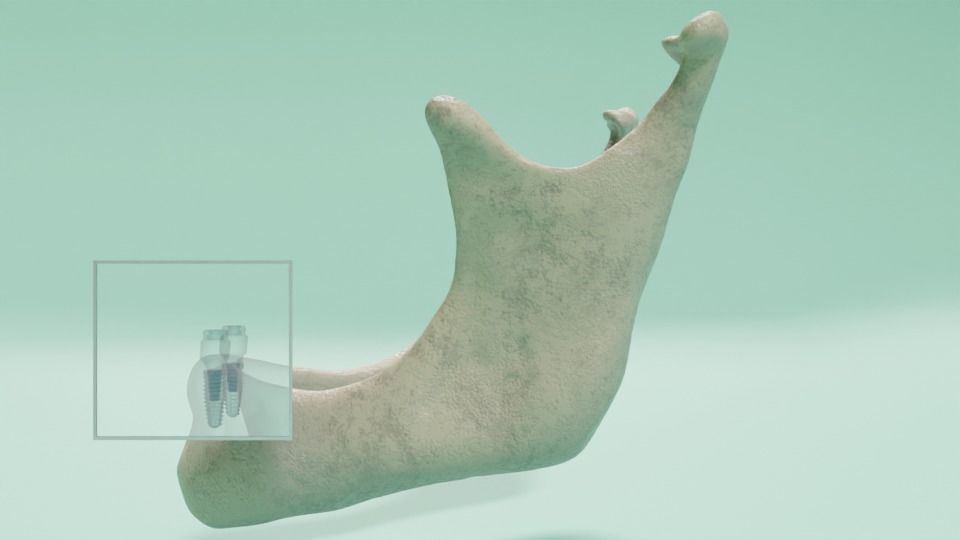 Overdenture lower denture retained by Oring-like abutments 3D model_5