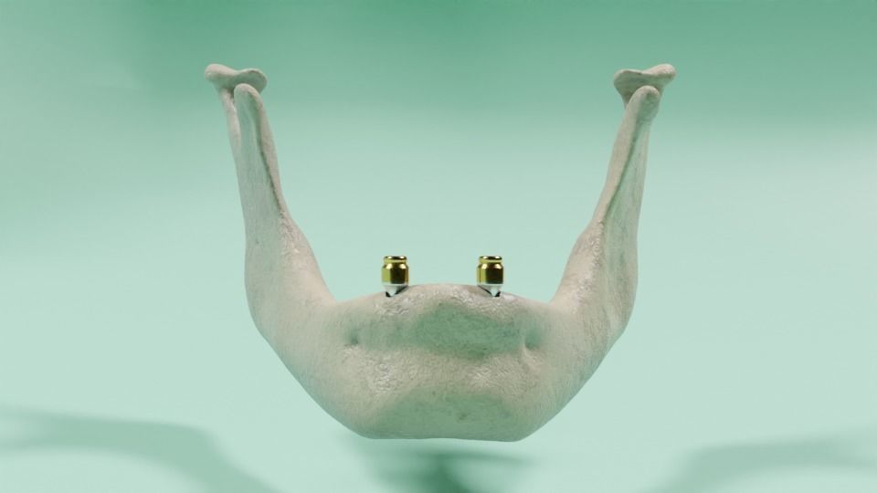 Overdenture lower denture retained by Oring-like abutments 3D model_4