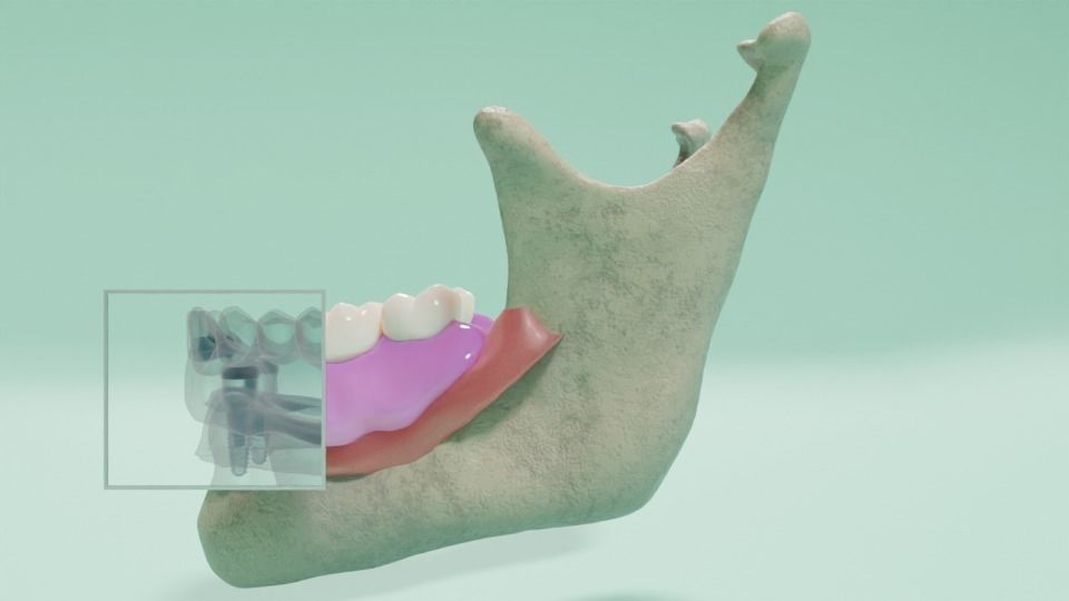 Overdenture lower denture retained by Oring-like abutments 3D model_1