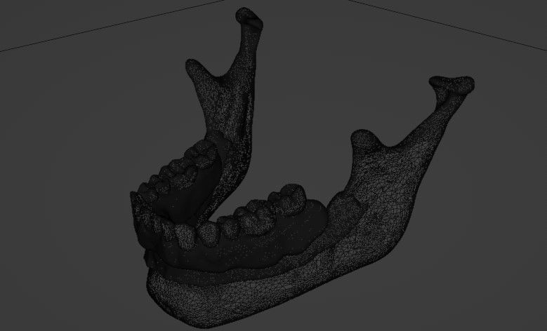 Overdenture lower denture retained by Oring-like abutments 3D model_7