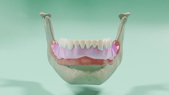 Overdenture lower denture retained by Oring-like abutments 3D model