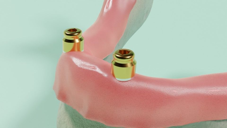 Overdenture lower denture retained by Oring-like abutments 3D model_3