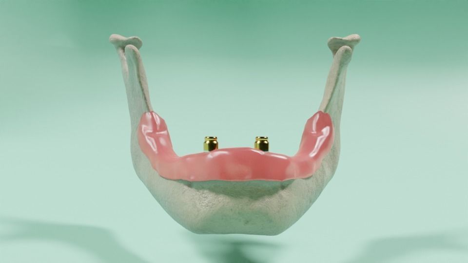Overdenture lower denture retained by Oring-like abutments 3D model_2