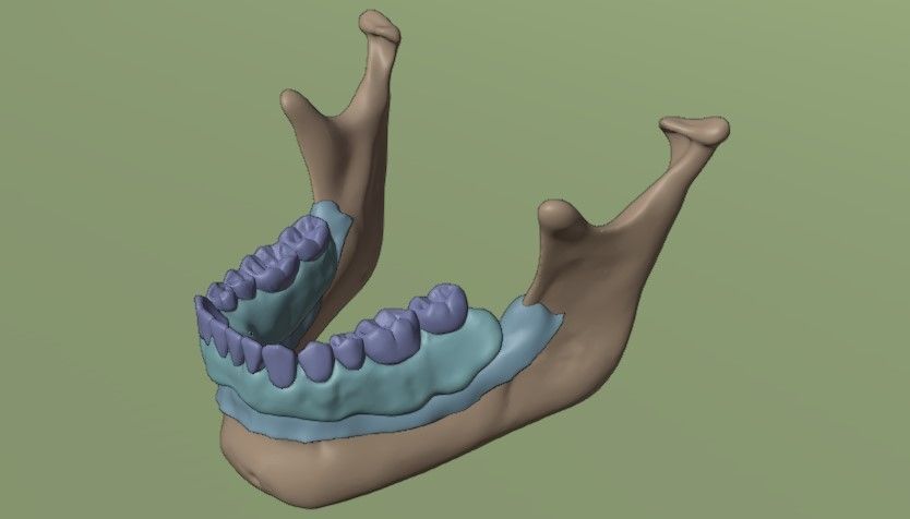 Overdenture lower denture retained by Oring-like abutments 3D model_6