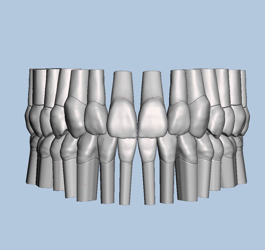 Dental Typodont with full crowns 3D print model_1