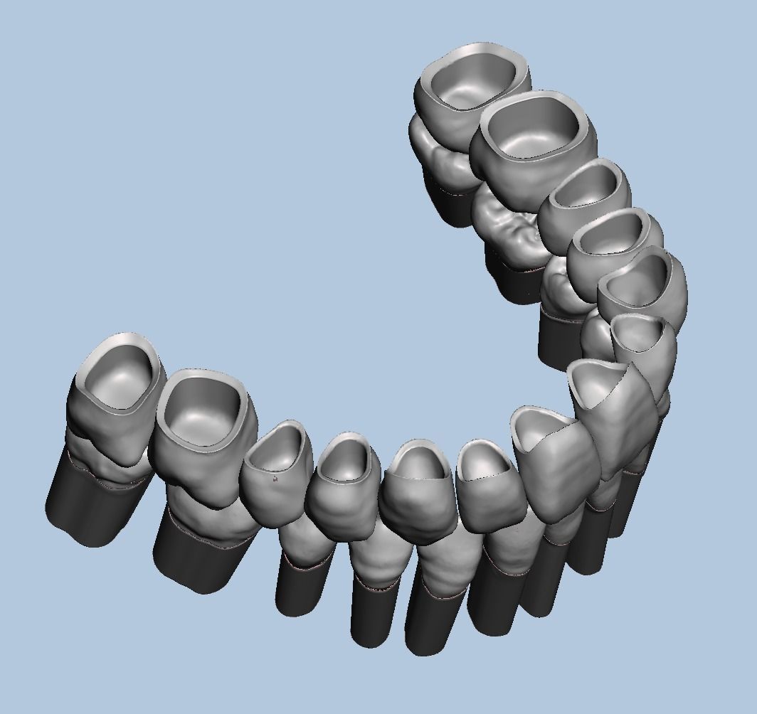 Dental Typodont with full crowns 3D print model_4