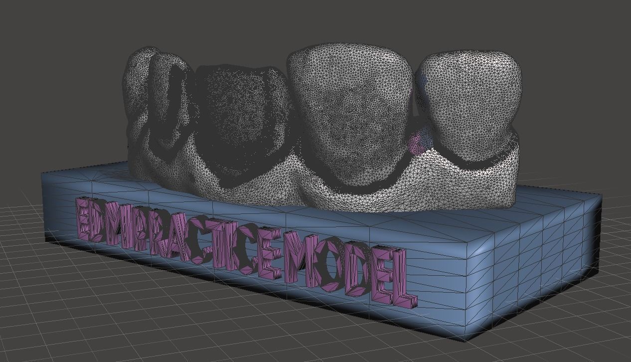 EDM Dental Practice Standard Model Direct Veneer  Sample 3D print model_4