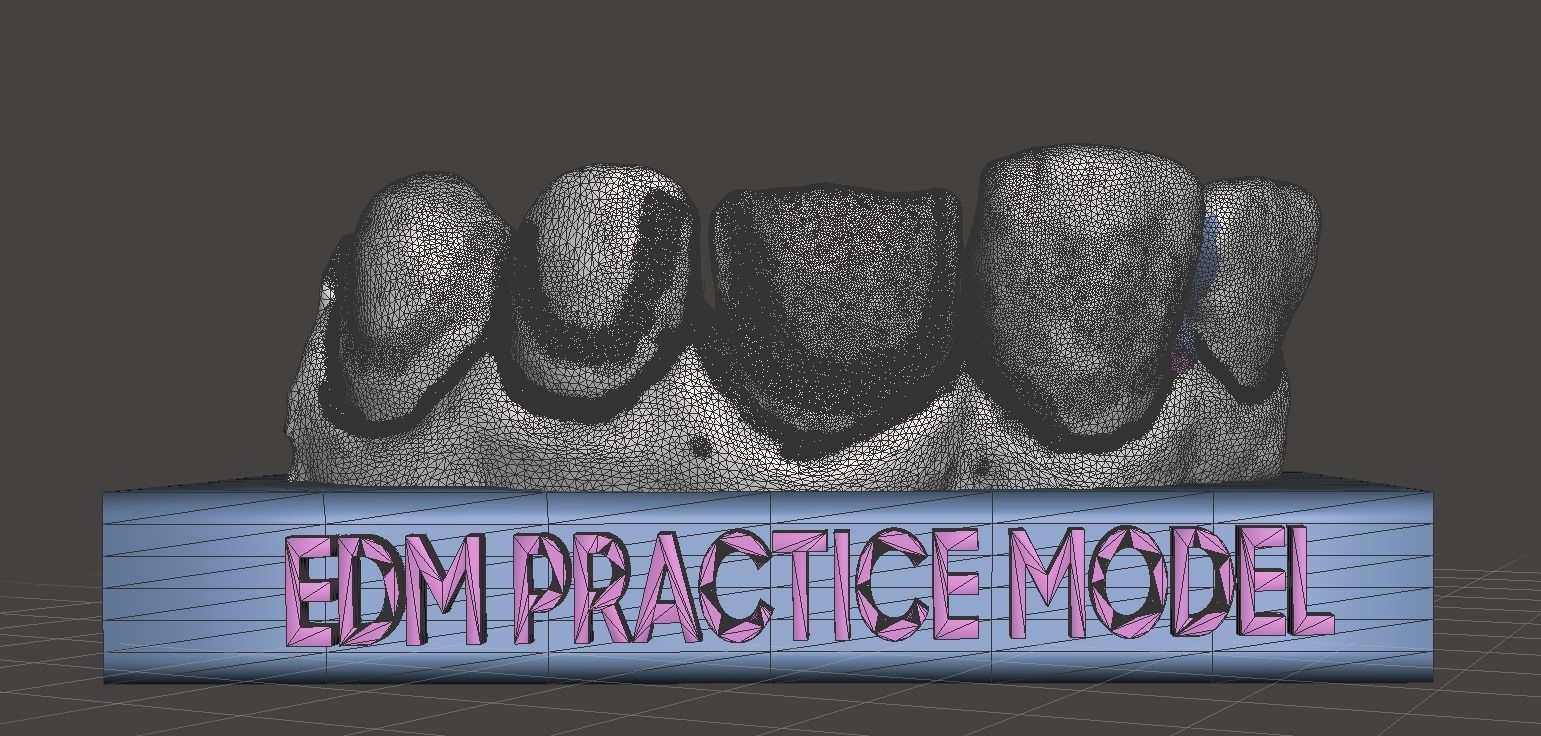 EDM Dental Practice Standard Model Direct Veneer  Sample 3D print model_2