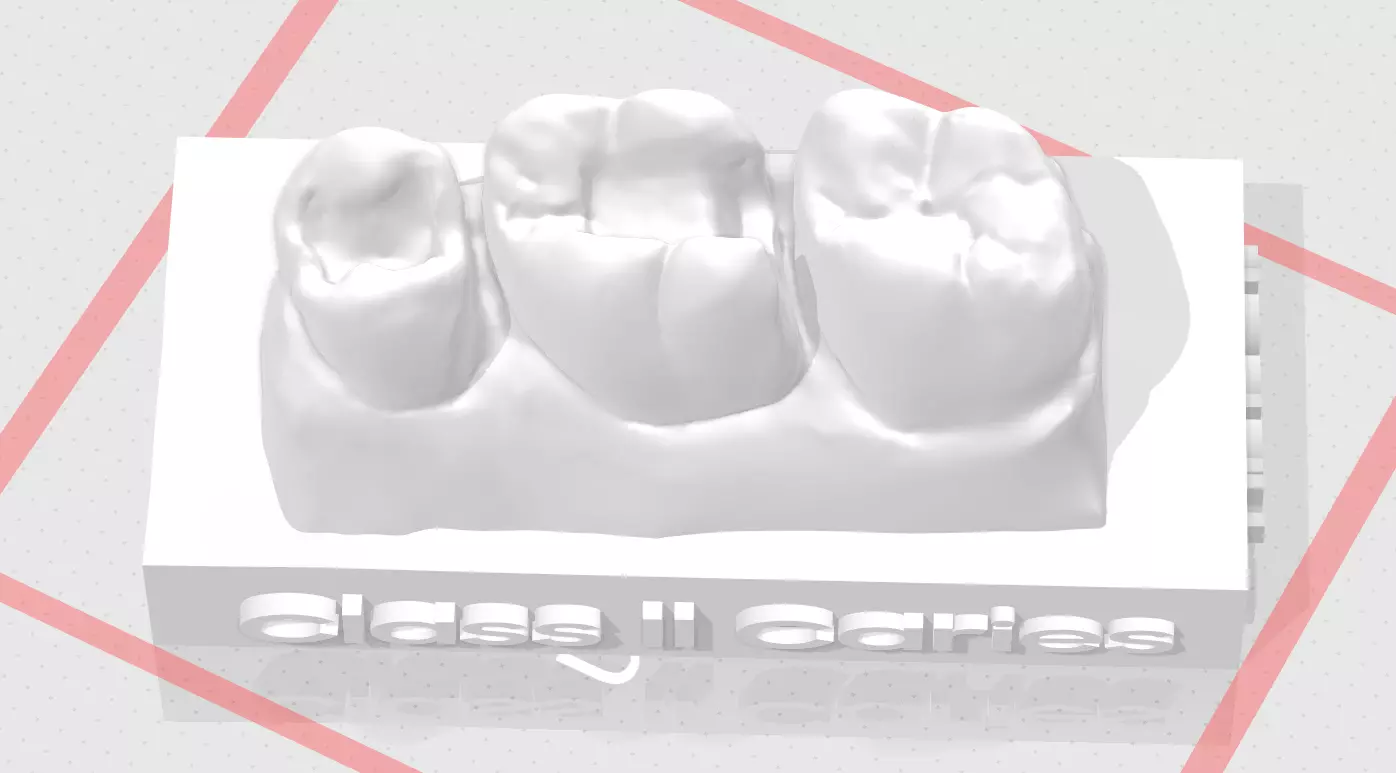 EDM Dental Practice Standard Upper Model Class 2 Sample 3D print model