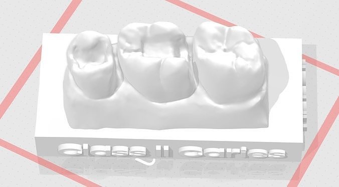 EDM Dental Practice Standard Upper Model Class 2  Sample 3D print model