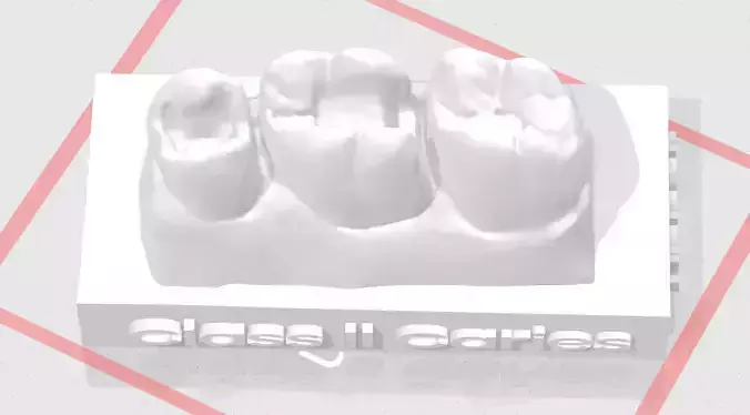 EDM Dental Practice Standard Upper Model Class 2  Sample 3D print model