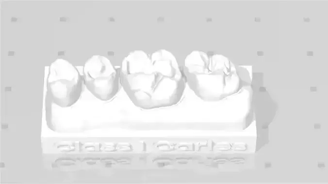 EDM Dental Practice Standard Upper Model Class 1  3D print model