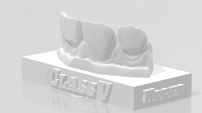 EDM Dental Practice Standard Upper Model Class 5 3D print model
