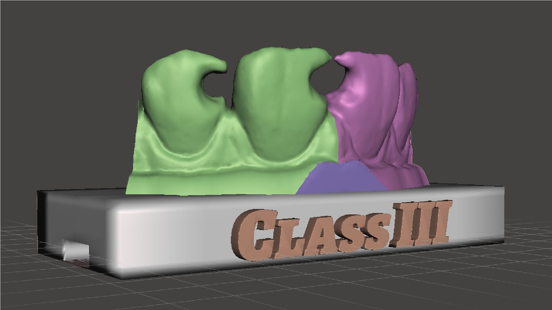 EDM Dental Practice Standard Upper Model Class 3 3D print model_4