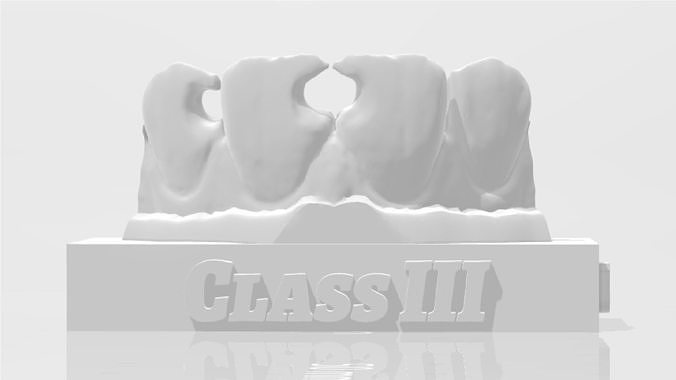 EDM Dental Practice Standard Upper Model Class 3 3D print model