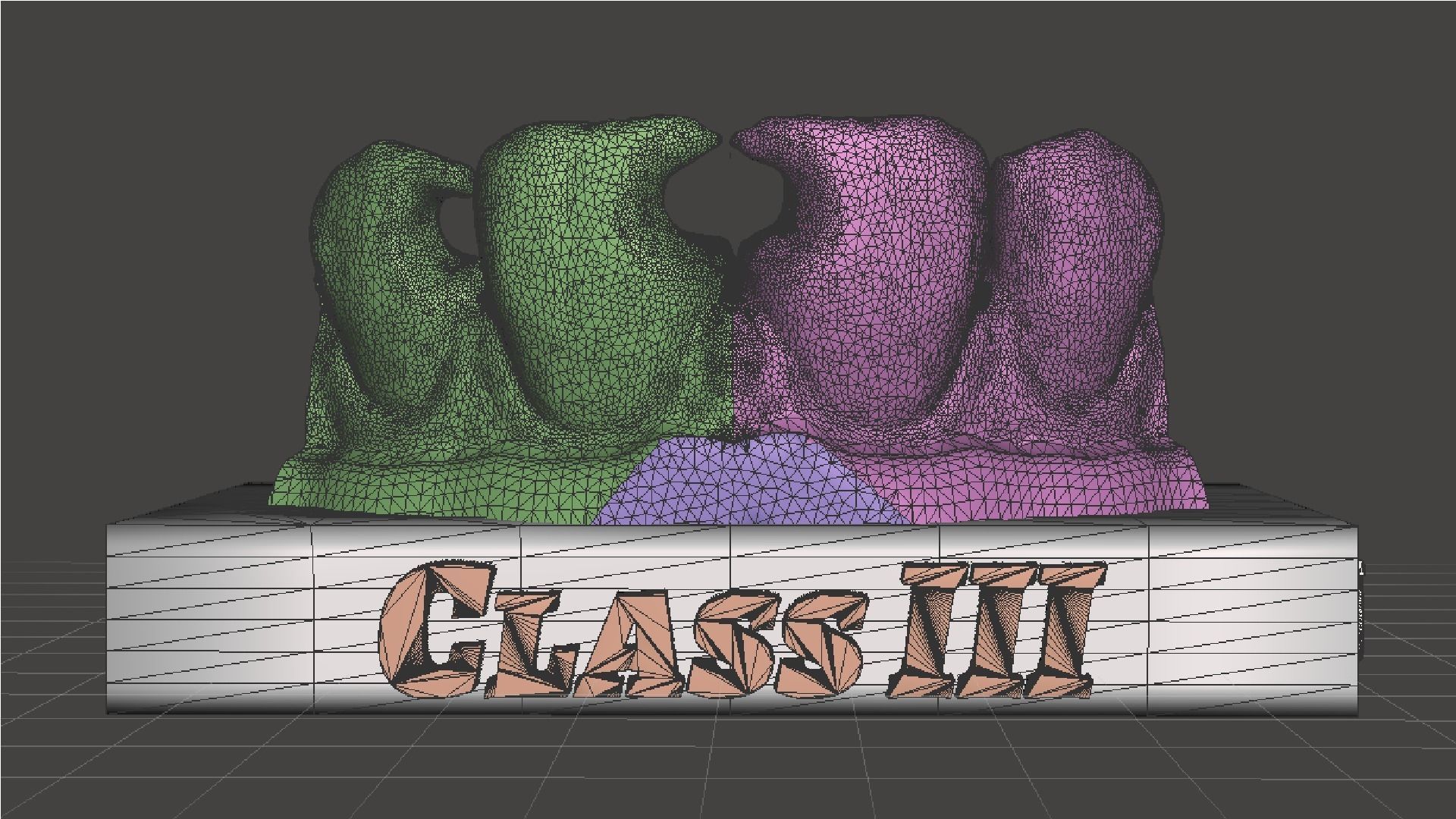 EDM Dental Practice Standard Upper Model Class 3 3D print model_6