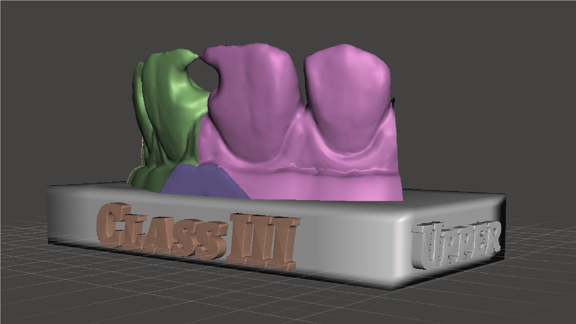 EDM Dental Practice Standard Upper Model Class 3 3D print model_5