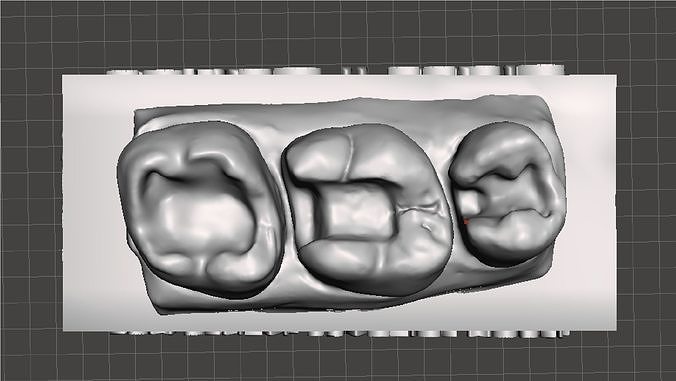 EDM Dental Practice Standard Upper Model Class 1 and 2 3D print model