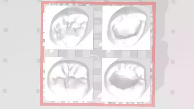 EDM Dental Practice High Detail Anatomy Focus 2nd Molar 