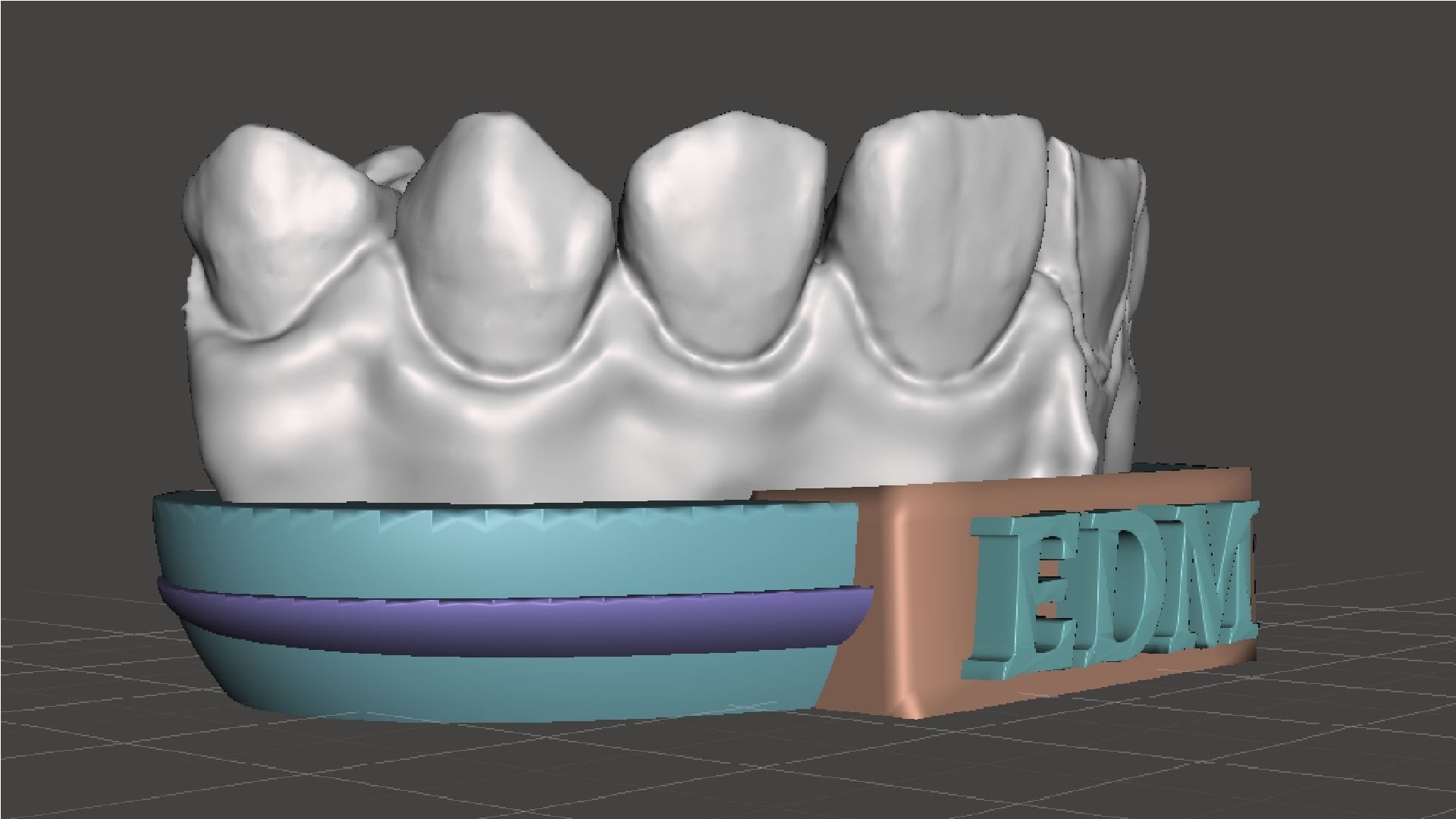 EDM Dental Practice Higher Quality Model Direct Veneer 3D print model_4
