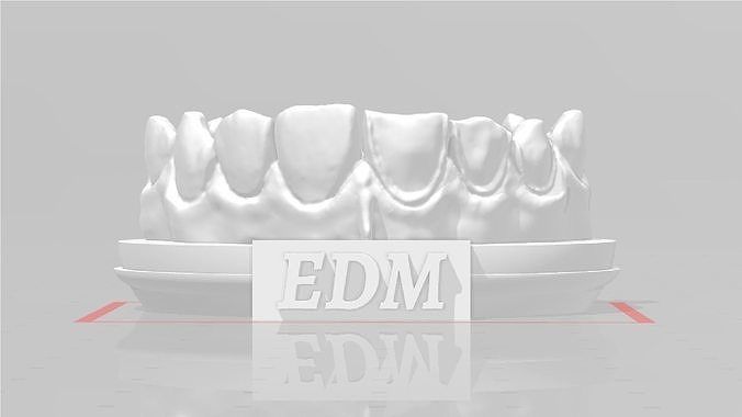 EDM Dental Practice Higher Quality Model Direct Veneer 3D print model