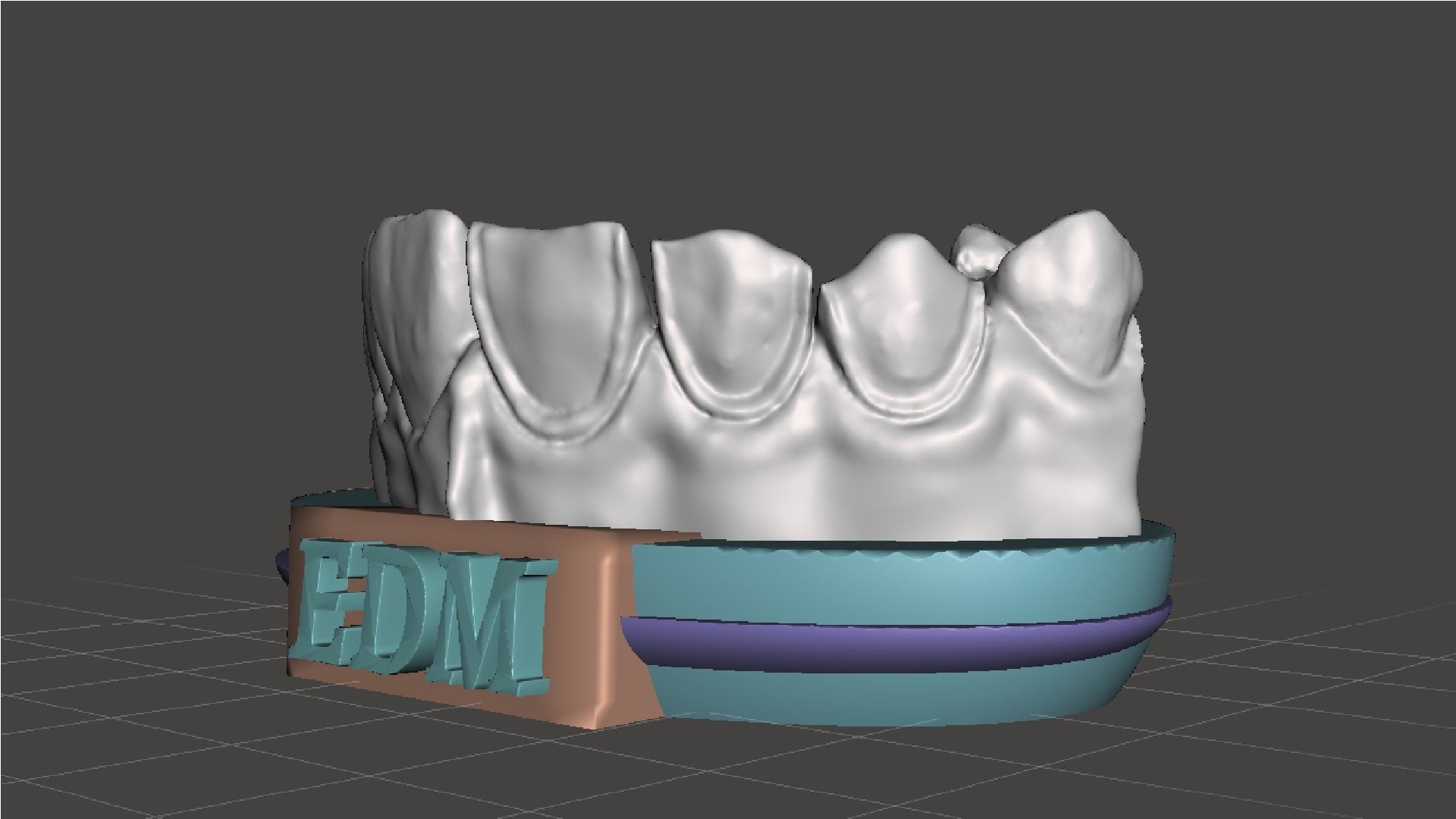 EDM Dental Practice Higher Quality Model Direct Veneer 3D print model_3