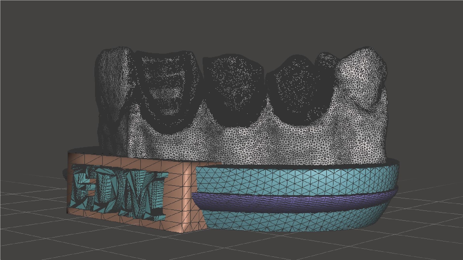 EDM Dental Practice Higher Quality Model Direct Veneer 3D print model_7