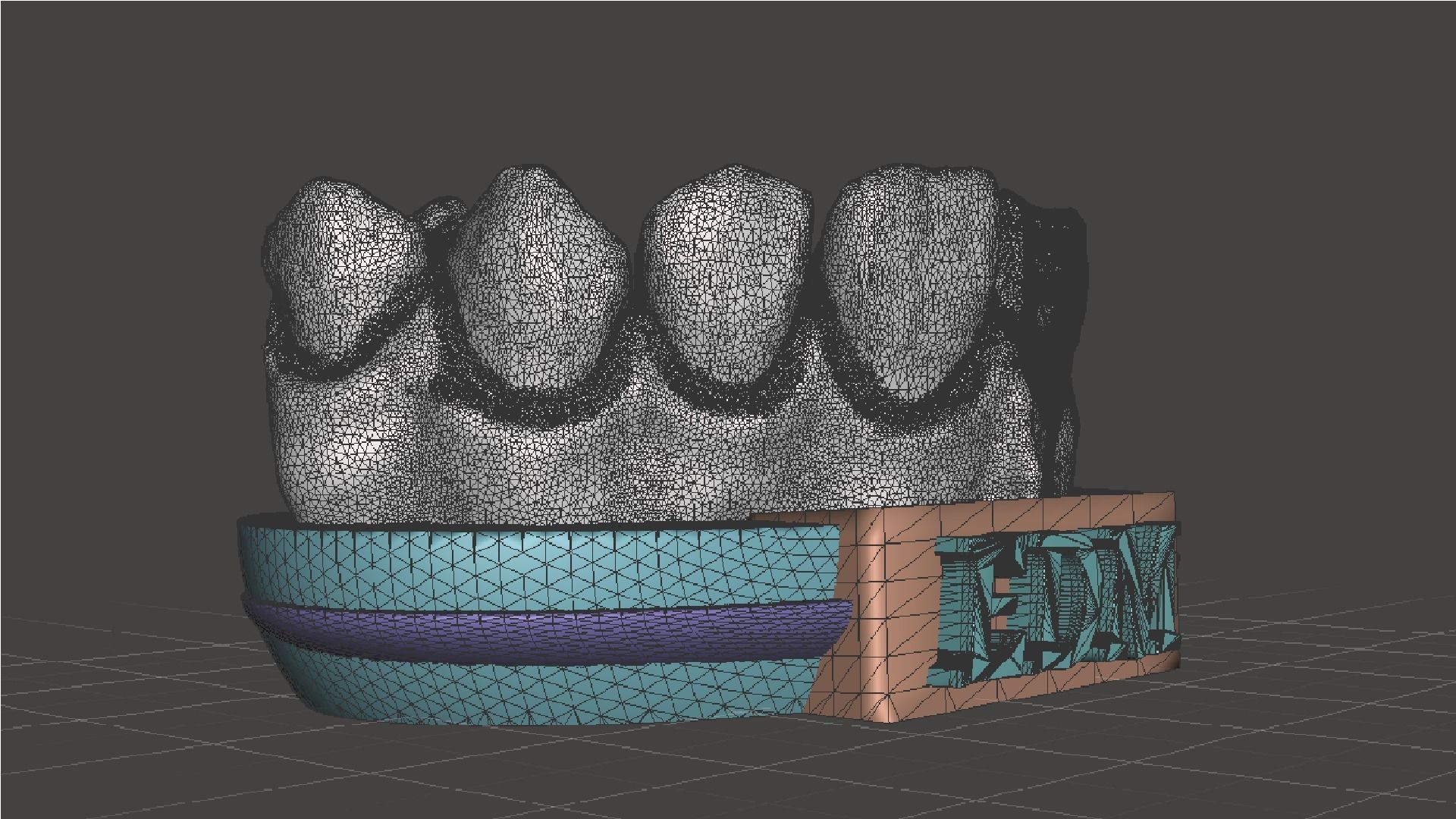 EDM Dental Practice Higher Quality Model Direct Veneer 3D print model_8