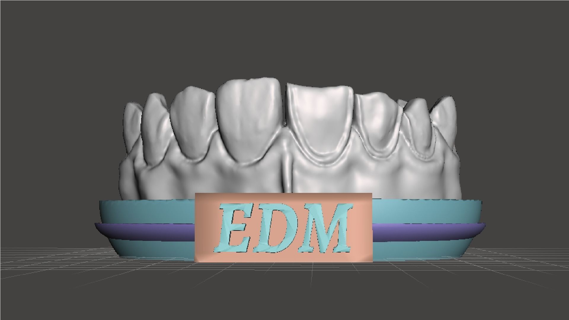 EDM Dental Practice Higher Quality Model Direct Veneer 3D print model_2