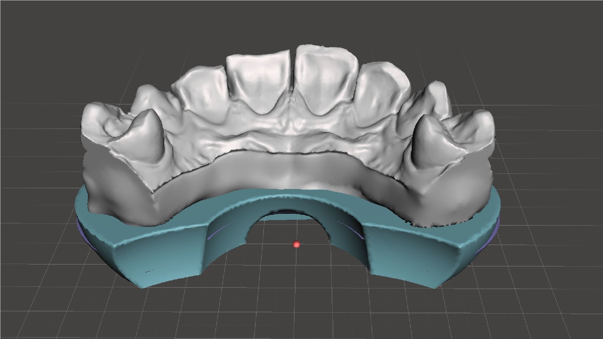 EDM Dental Practice Higher Quality Model Direct Veneer 3D print model_1