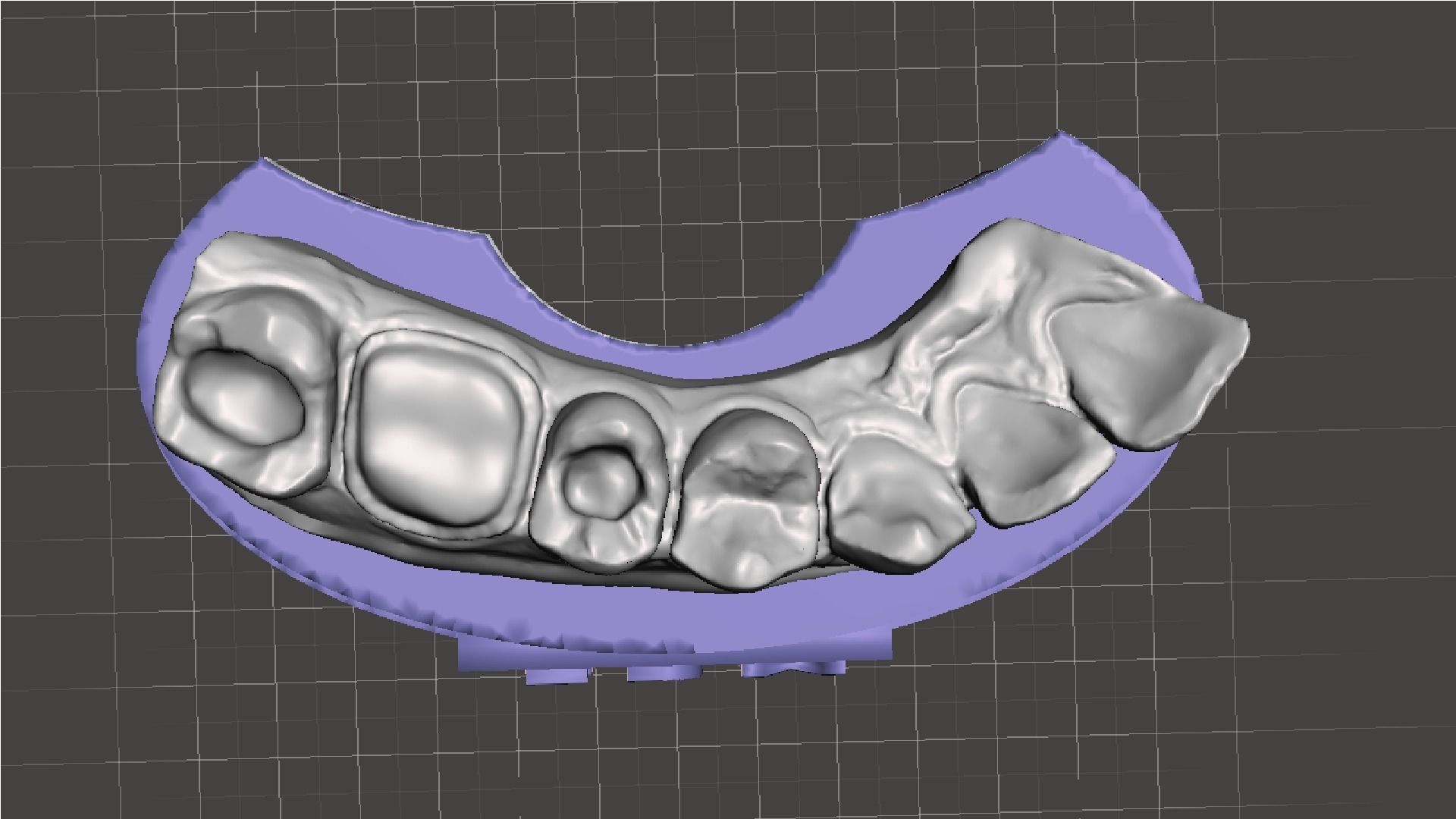 EDM Dental Practice Model Crown and Class 1 3D print model_5