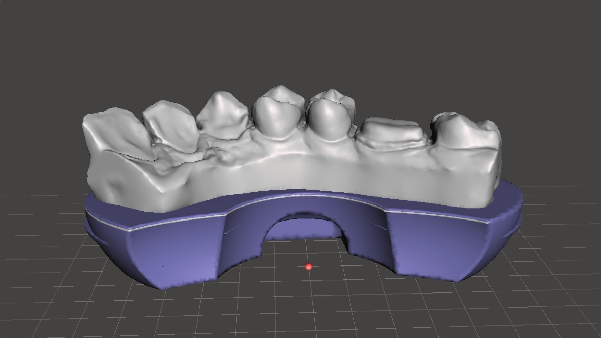 EDM Dental Practice Model Crown and Class 1 3D print model_3