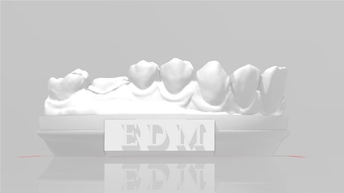 EDM Dental Practice Model Crown and Class 1 3D print model