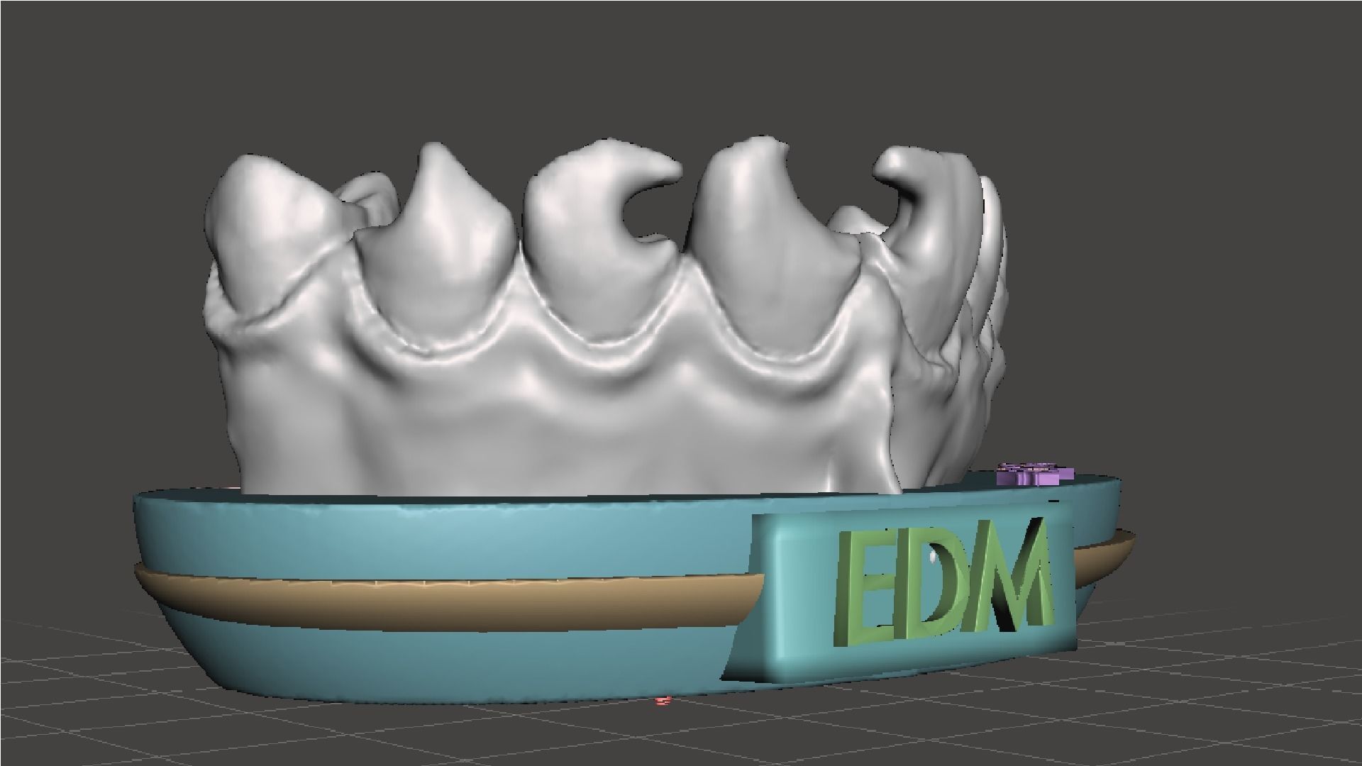 EDM Dental Practice Exclusive Model Class 3 and 4 3D print model_7