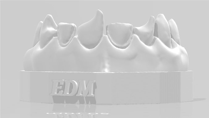 EDM Dental Practice Exclusive Model Class 4 and Direct Veneer 3D print model