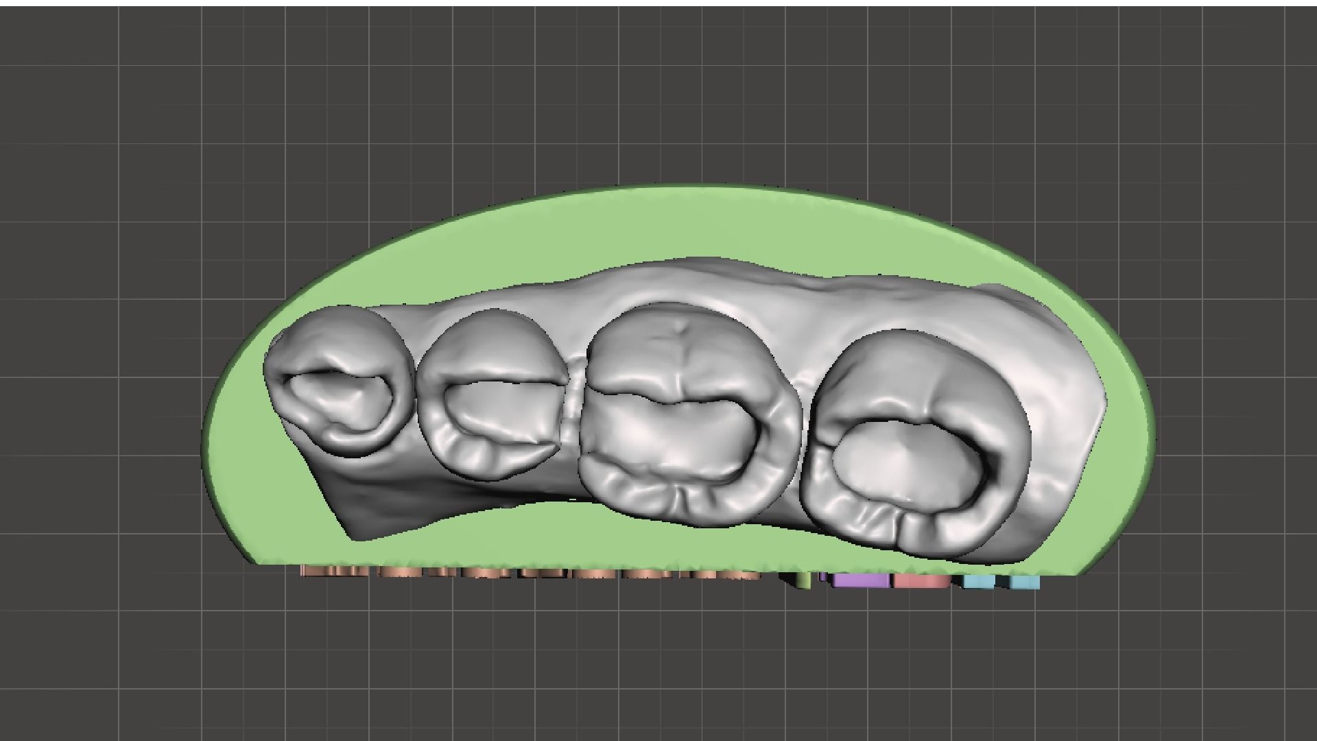 EDM Dental Practice Exclusive Model Lower Class 1 and 2 3D print model_7