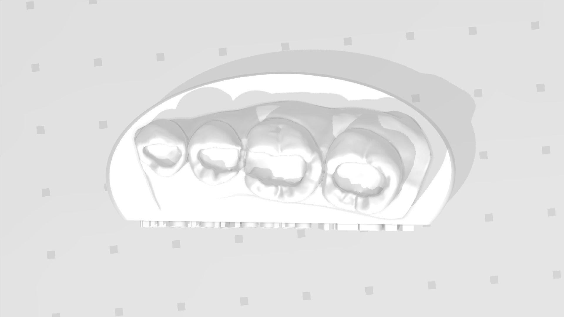 EDM Dental Practice Exclusive Model Lower Class 1 and 2 3D print model_6
