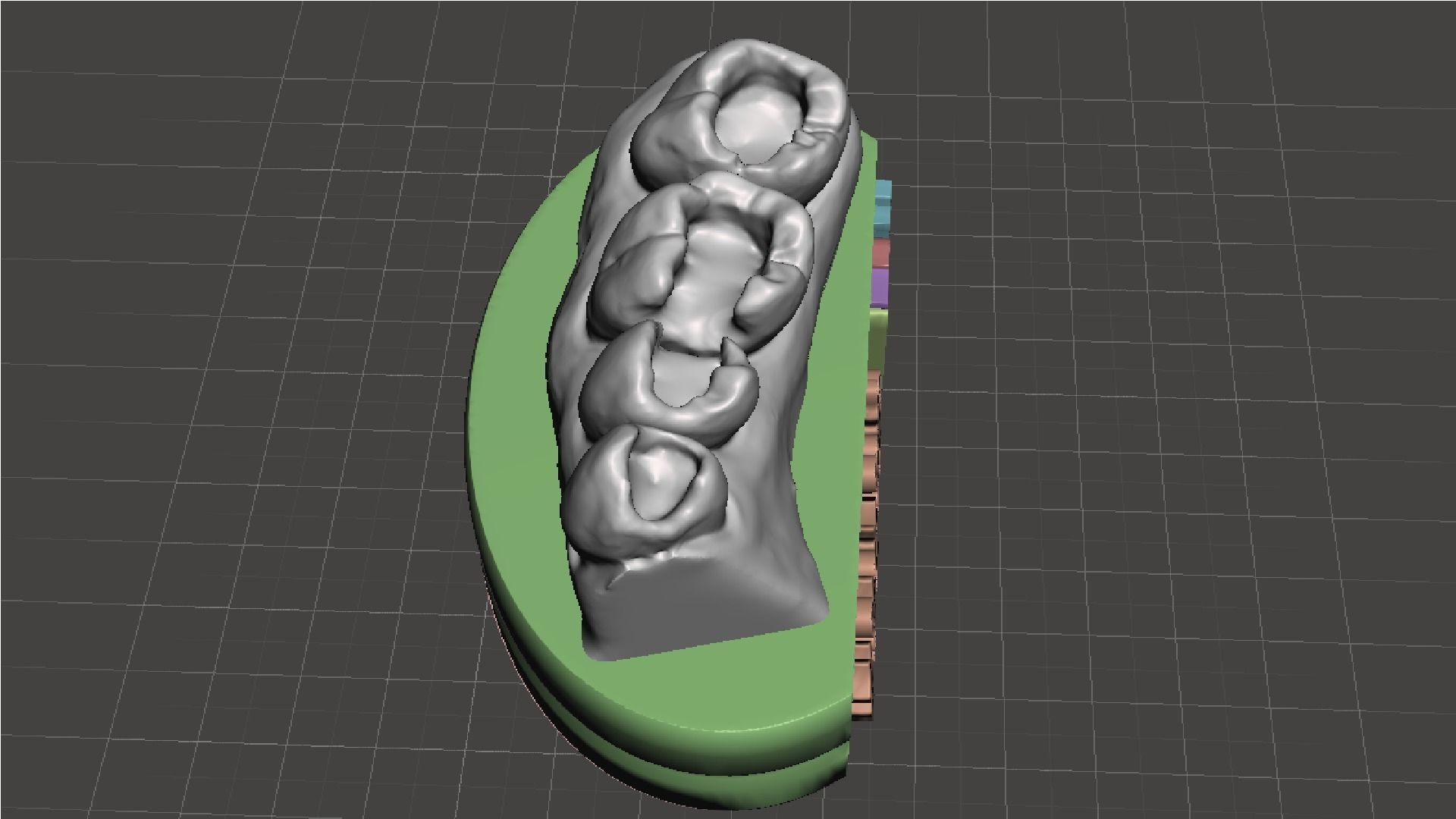 EDM Dental Practice Exclusive Model Lower Class 1 and 2 3D print model_5