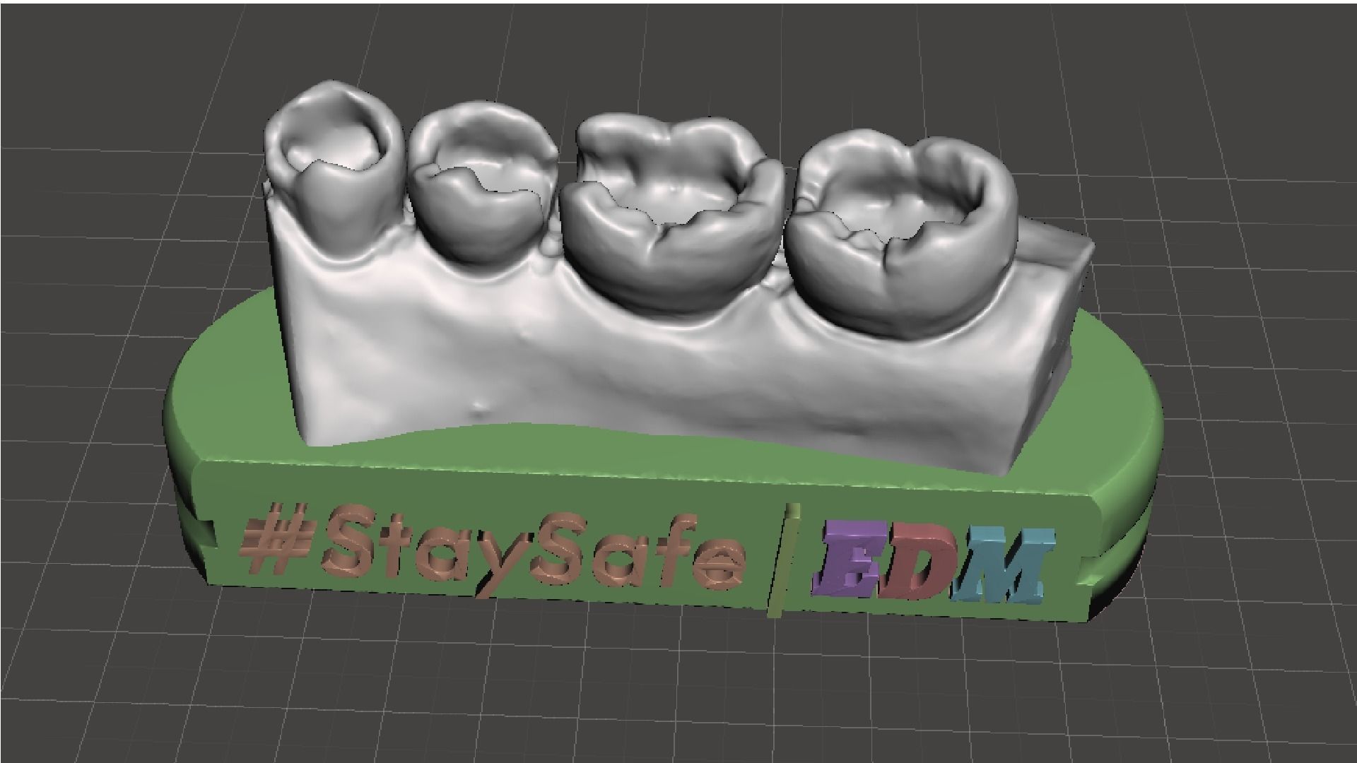 EDM Dental Practice Exclusive Model Lower Class 1 and 2 3D print model_2