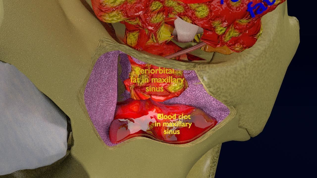 Blowout eye injury and fracture 3D model_7