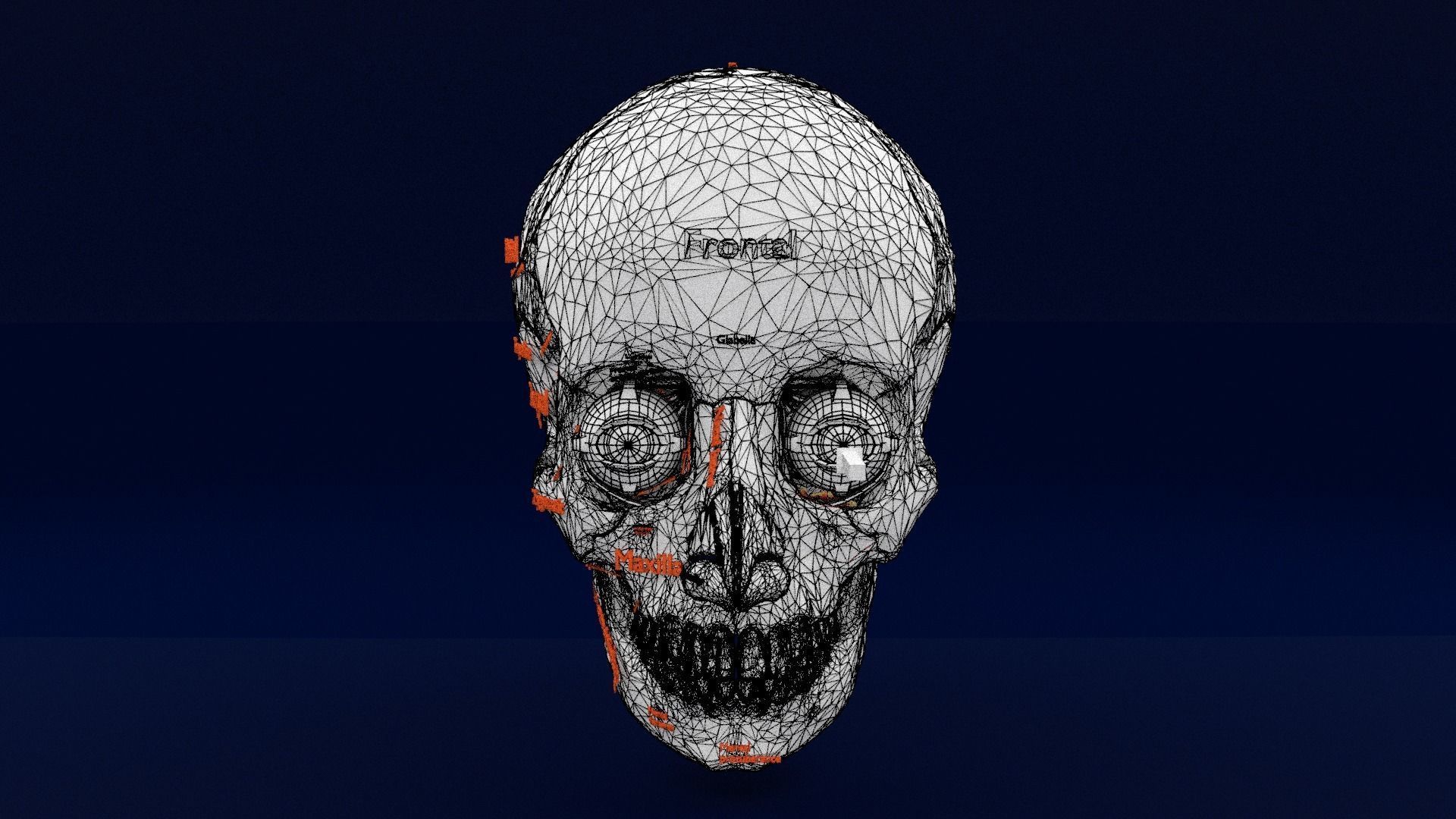 Blowout eye injury and fracture 3D model_48