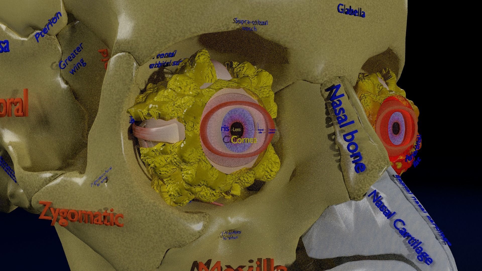 Blowout eye injury and fracture 3D model_45