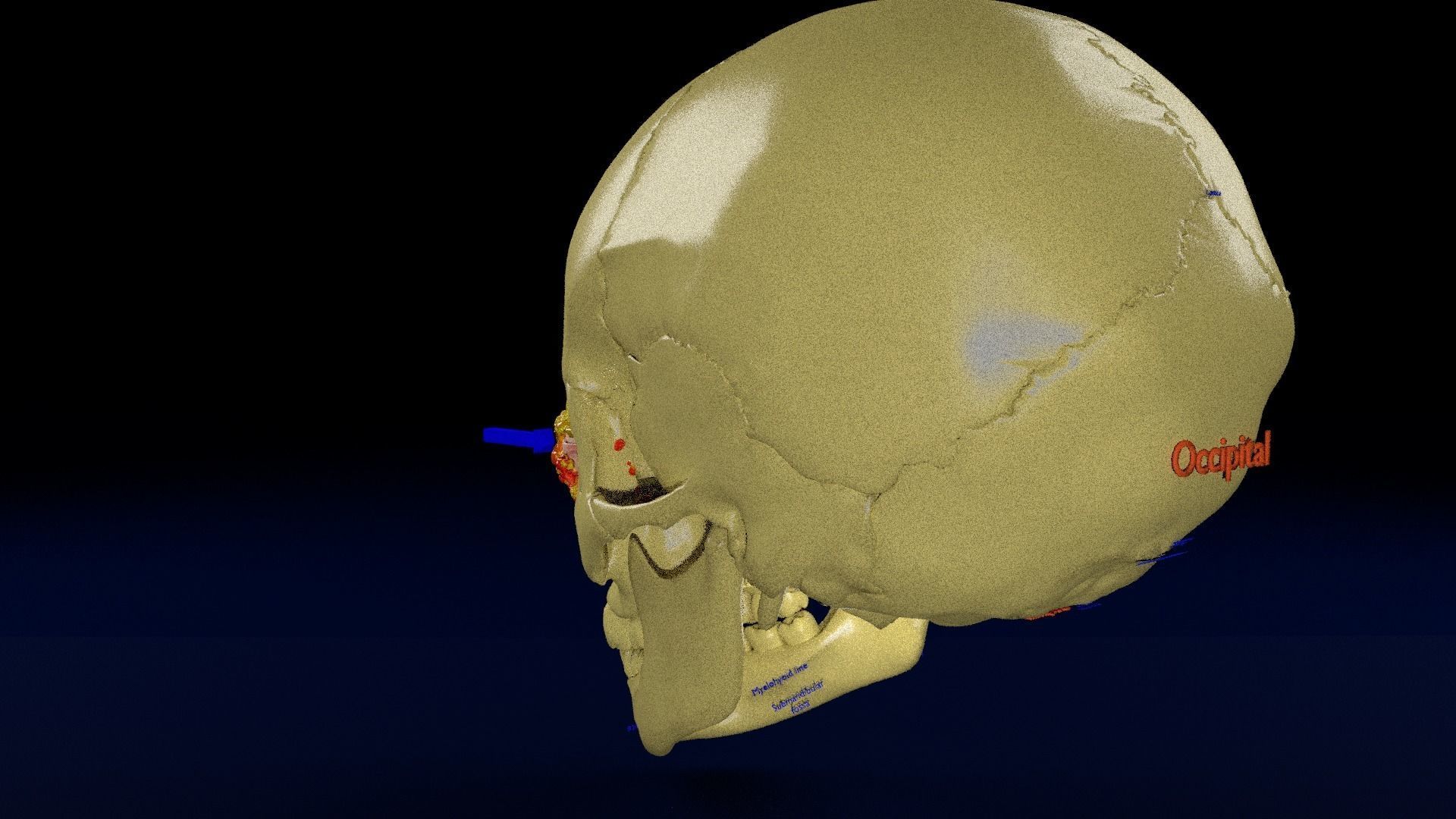 Blowout eye injury and fracture 3D model_30
