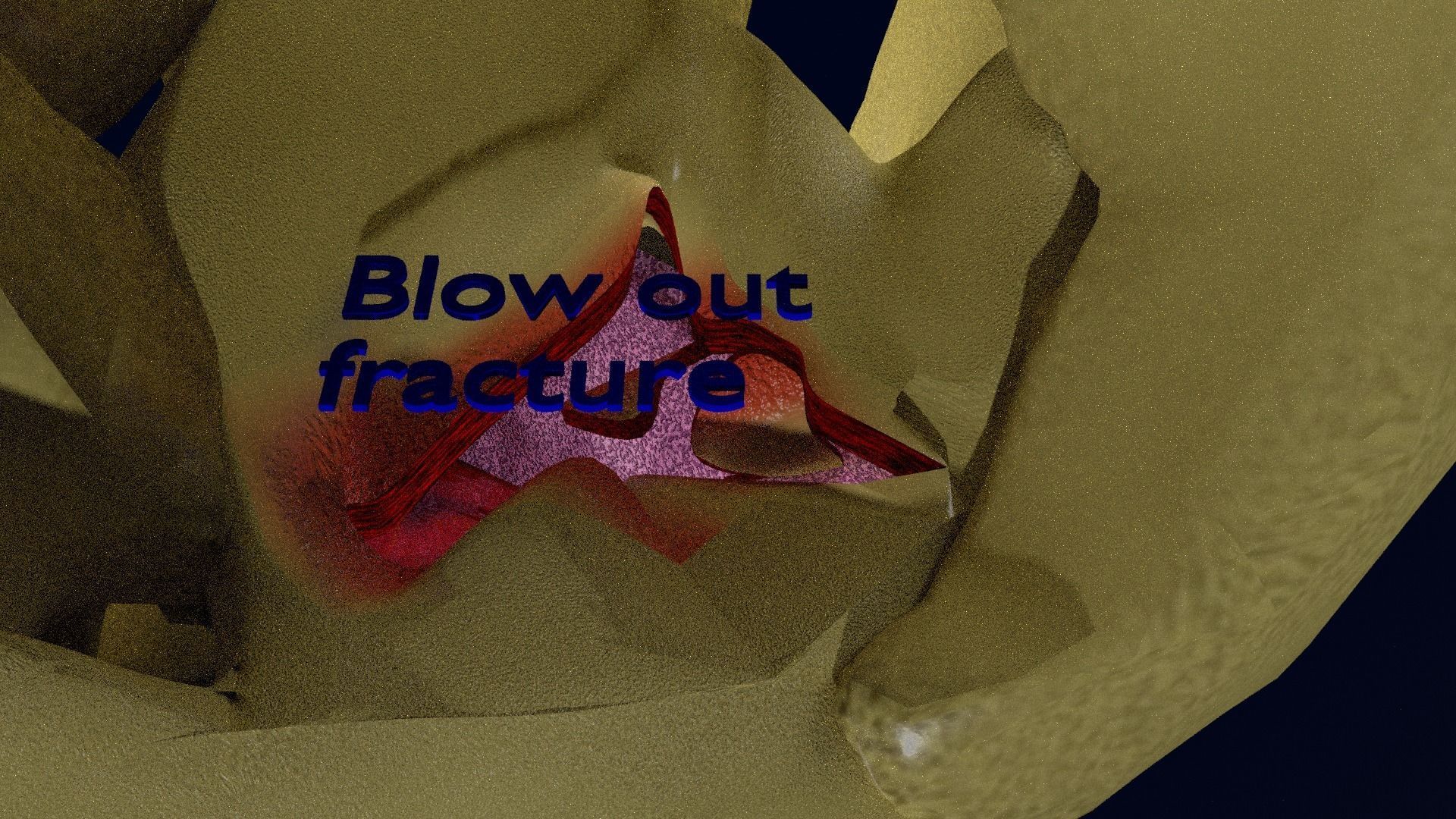 Blowout eye injury and fracture 3D model_43