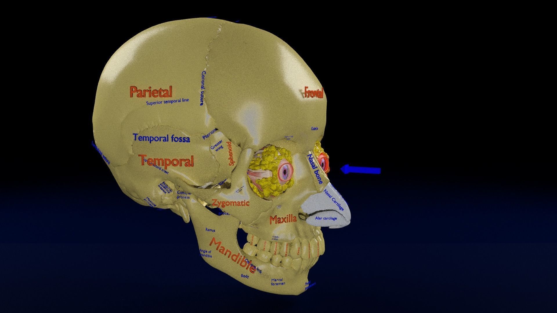 Blowout eye injury and fracture 3D model_19