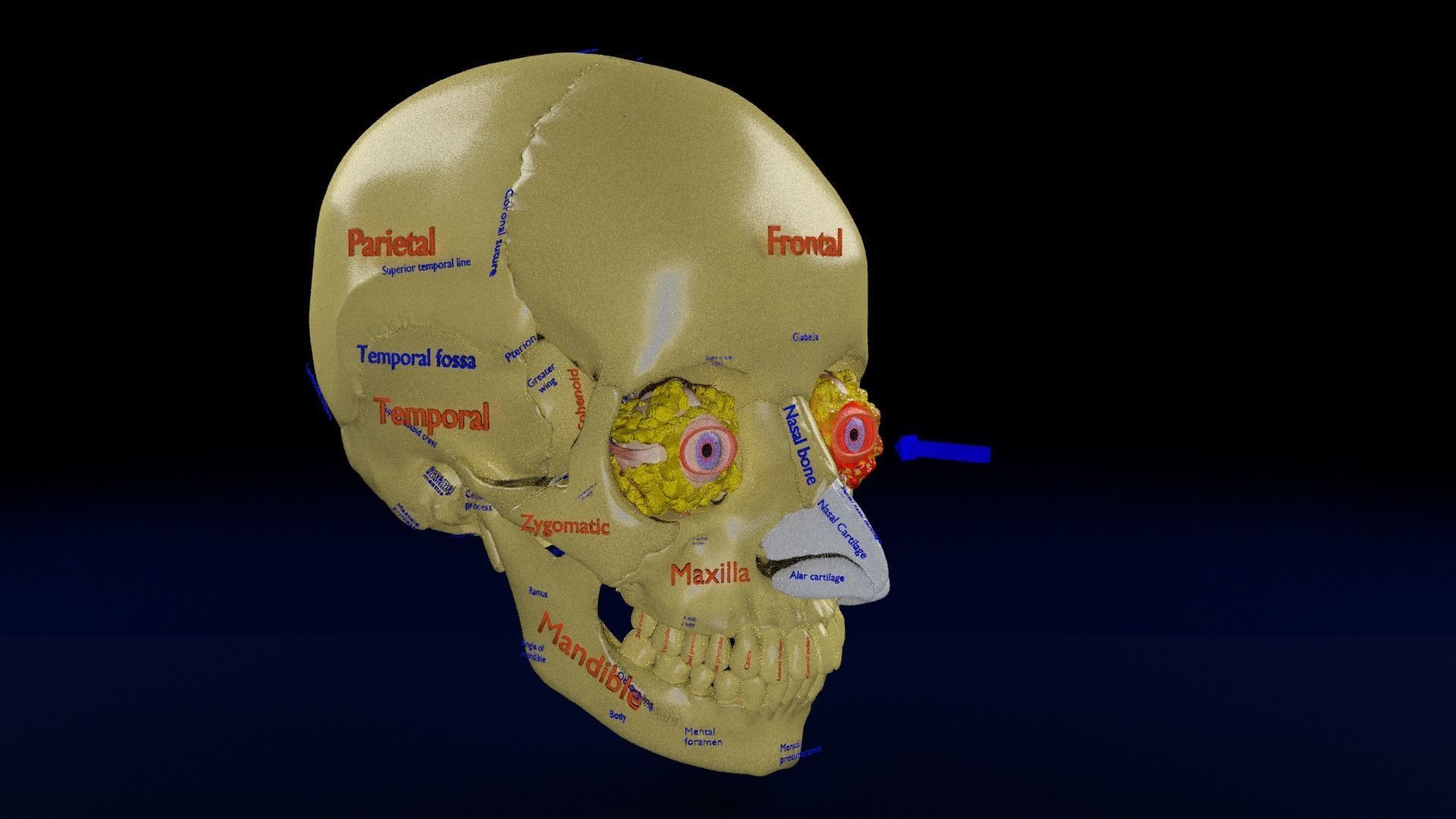 Blowout eye injury and fracture 3D model_18