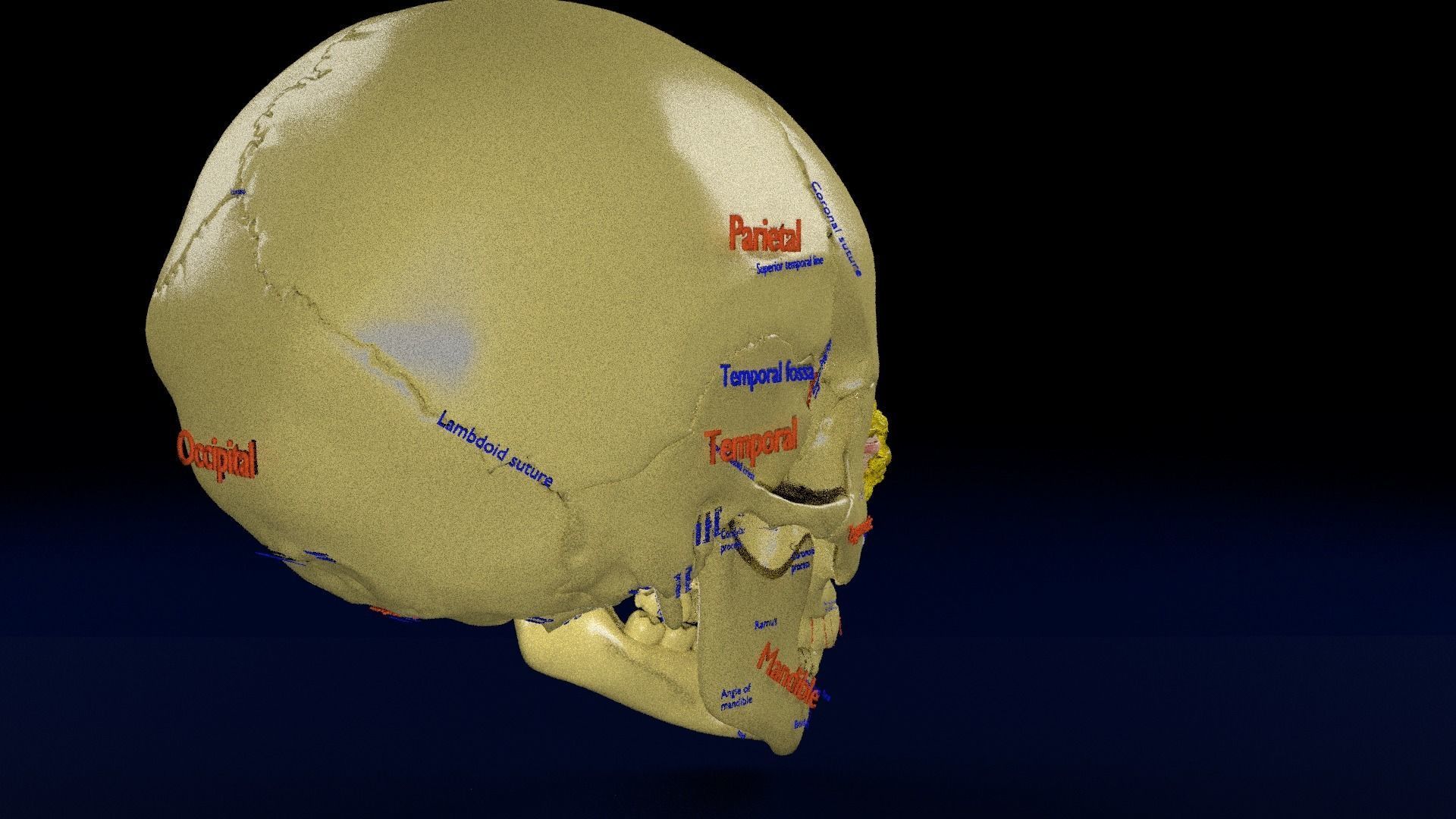 Blowout eye injury and fracture 3D model_24