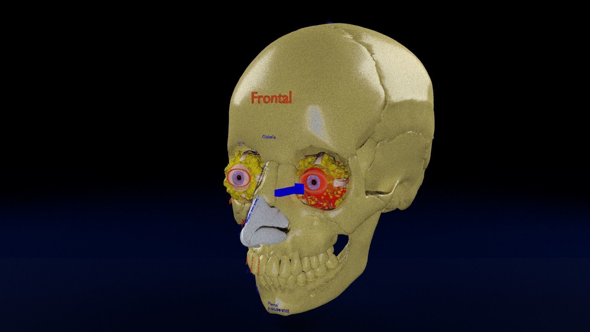 Blowout eye injury and fracture 3D model_37