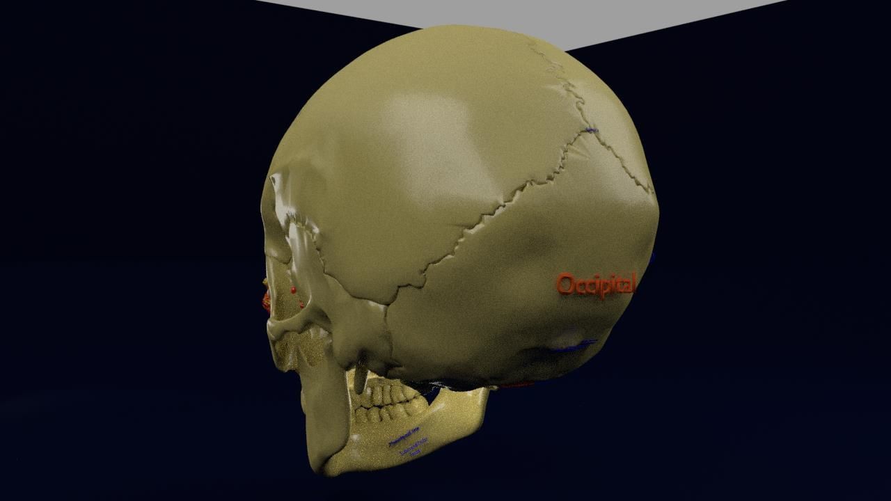 Blowout eye injury and fracture 3D model_12