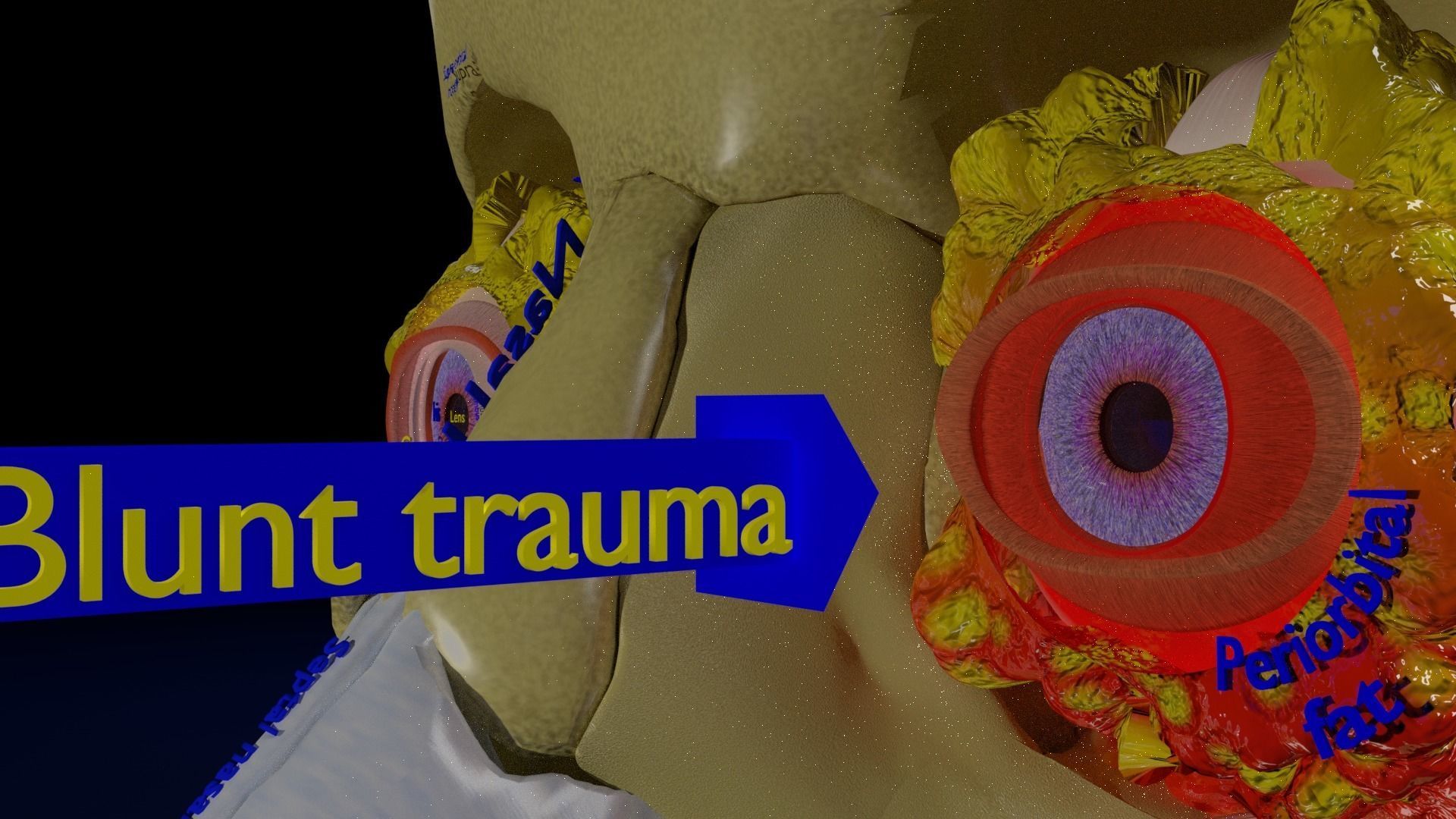 Blowout eye injury and fracture 3D model_40